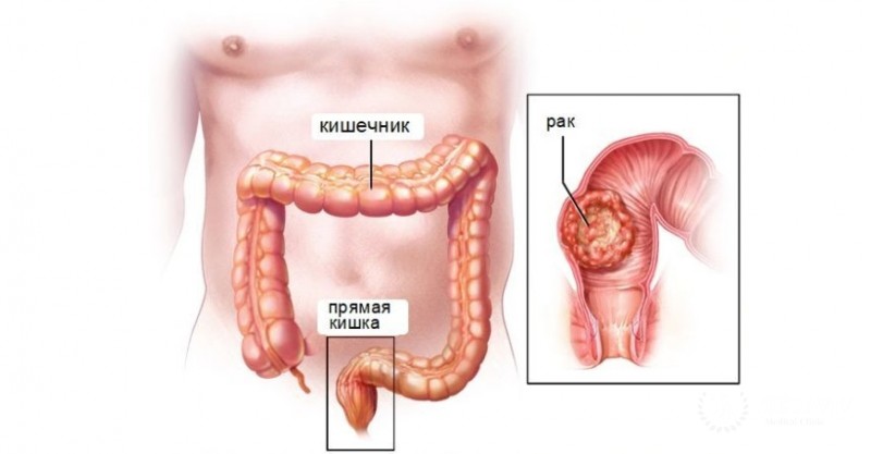 Причины появления и симптомы аденокарциномы