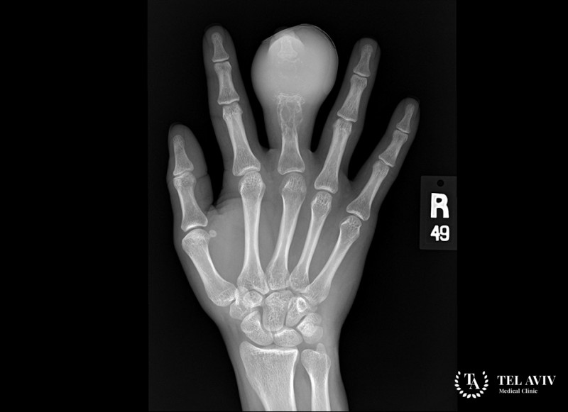 Саркома Юинга