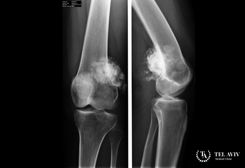 Остеоскаркома