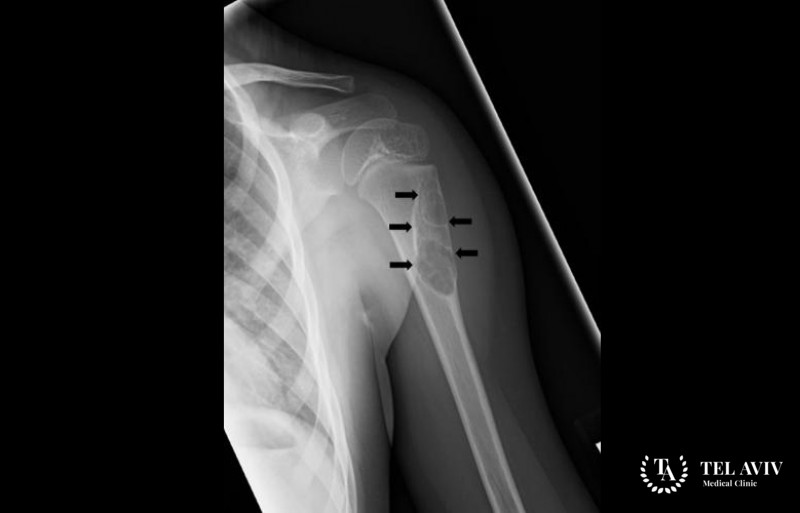 Костные кисты