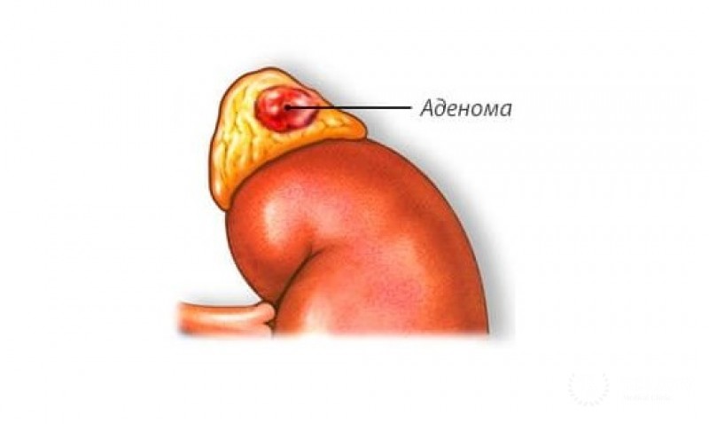 Аденомы надпочечников