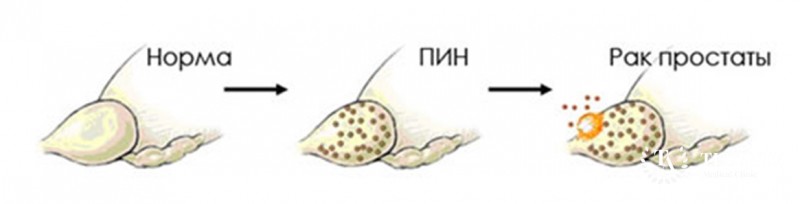 Солидный рак предстательной железы