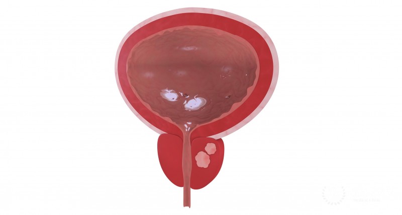 Плоскоклеточный рак предстательной железы