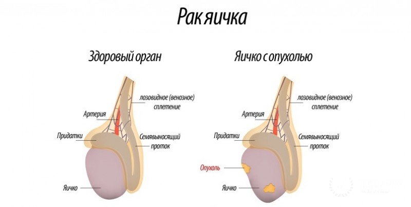 Лимфома (локальная форма неходжкинской лимфомы) яичка