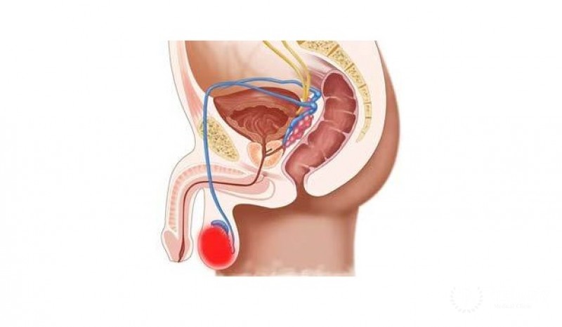 Тератома яичка
