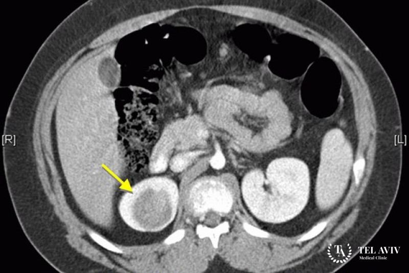 Нефробласто́ма (опухоль Вильмса)