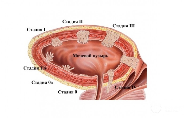 Карцинома мочевого пузыря