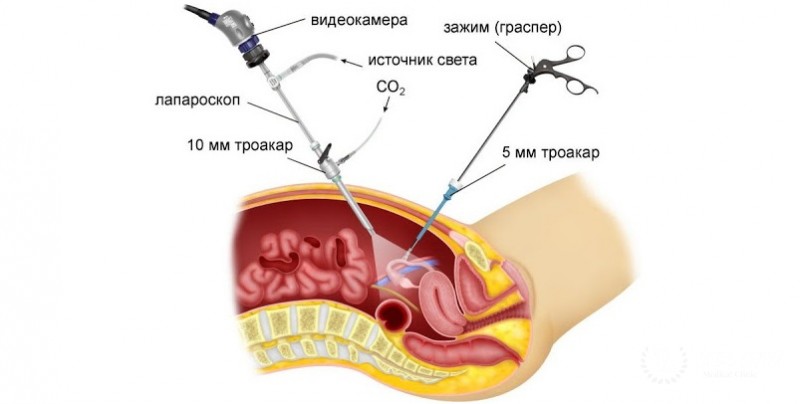 Проведение диагностической лапароскопии