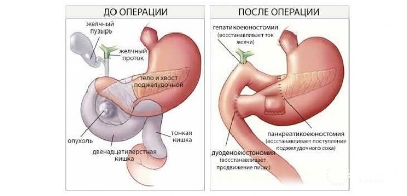 Операция Уиппла
