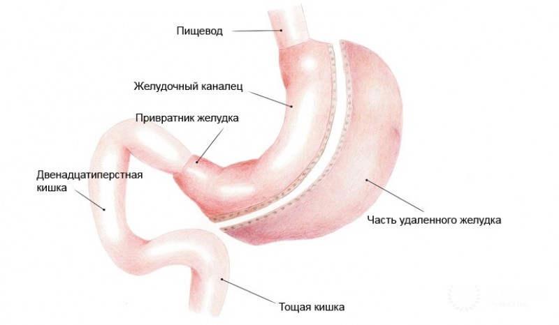 Лапароскопическая гастроэктомия – преимущества инновационного метода
