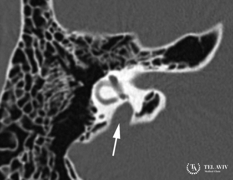 Gusher-синдром: описание симптоматика заболевания