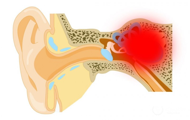 Болезнь Когана: симптоматика, диагностика, лечение