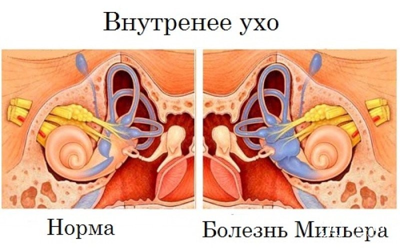 Болезнь Меньера: симптомы, способы диагностики, лечение