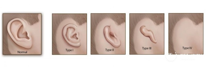 Микротия: перечень необходимых исследований, формы, причины развития патологии