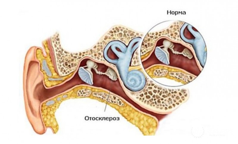 Отосклероз: симптомы, причины, лечение болезни
