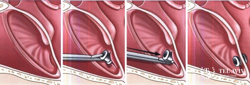 Миринготомия: цель процедуры, показания к проведению