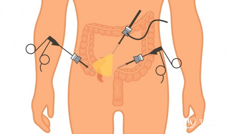 Аппендикс - почему необходима операция?