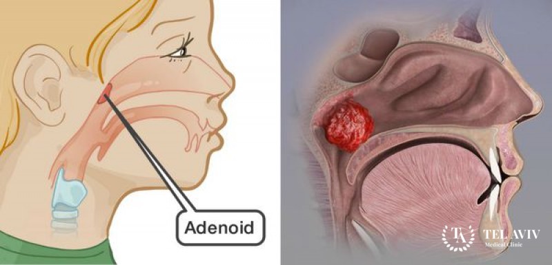 Аденоидит: симптомы, методы диагностики