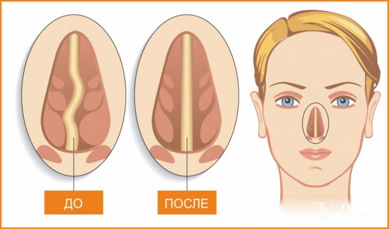 Искривление перегородки носа: классификация