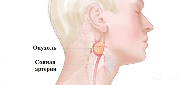 Опухоли головы и шеи - информация