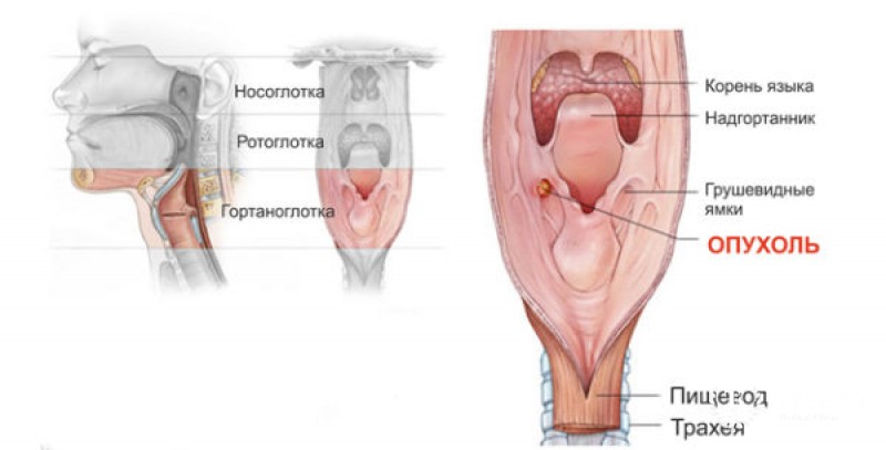 Киста голосовой связки: лечение