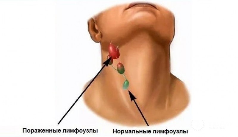 Новообразования в лимфоузлах шеи: лечение
