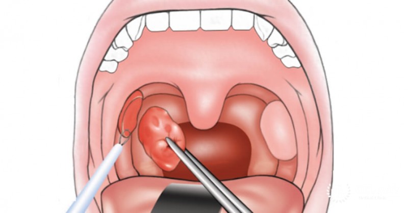 Опухоли полости рта: лечение