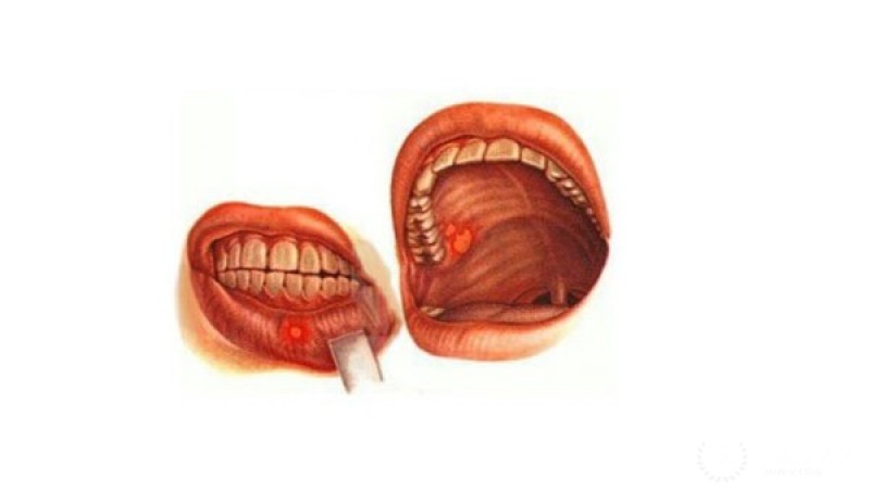 Железисто-кистозная карцинома ротовой полости