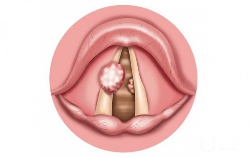 Папилломатоз гортани: симптоматика, виды