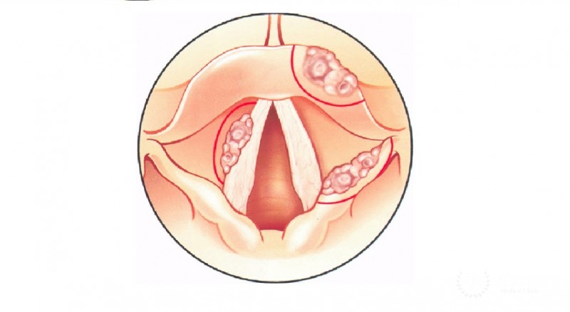 Рак голосовых связок: симптомы, лечение