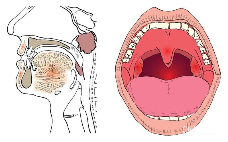 Рак ротоглотки: факторы