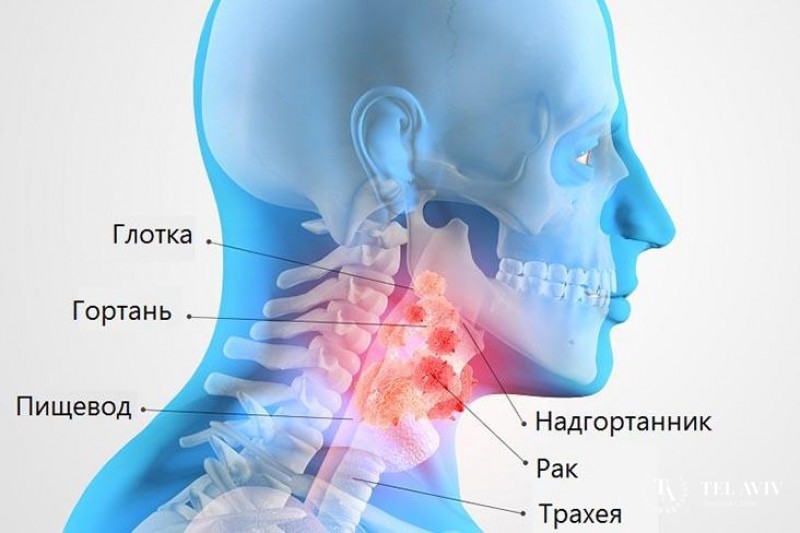 Плоскоклеточный рак гортани (горла) неороговевающий