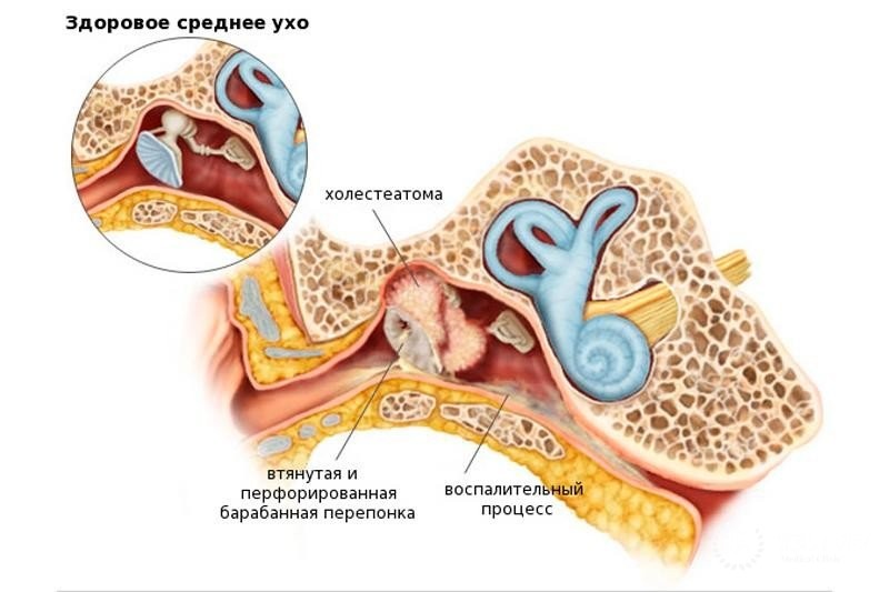 Холестеато́ма: признаки болезни