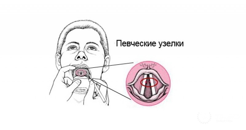 Узелки голосовых связок: лечение