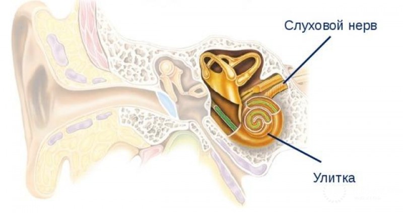 Повреждение слухового нерва