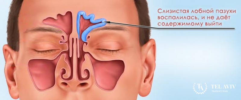 Фронтит - лечение