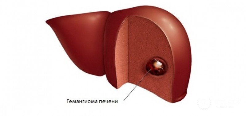 Образования печени