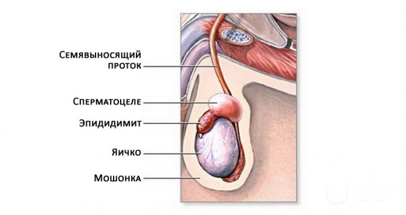 Образования яичка и придатка