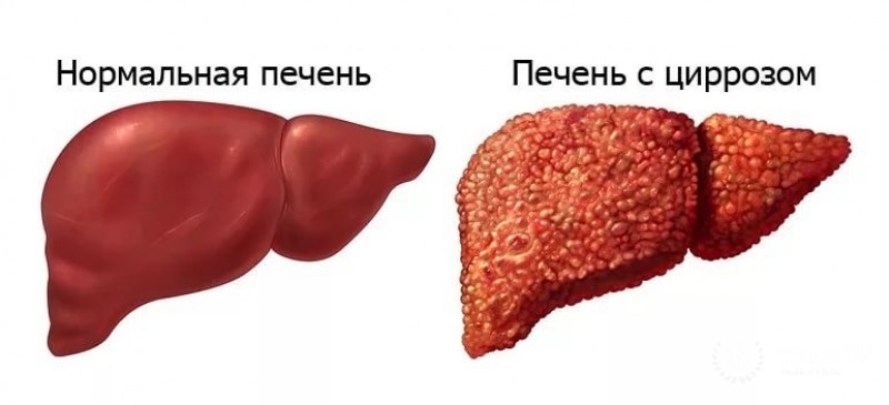 Цирроз печени - почему он опасен?