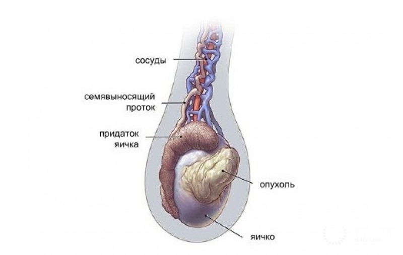 Семинома яичка