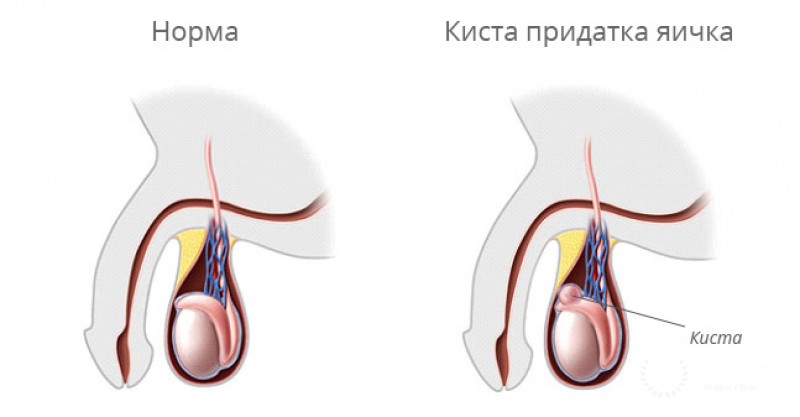 Киста яичка - признаки появления