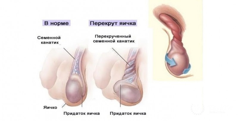 Перекрут яичка - признаки патологии