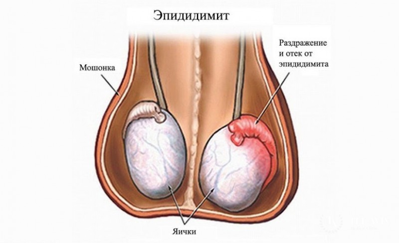 Эпидидимит