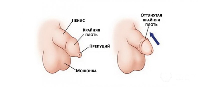 Фимоз - что это?