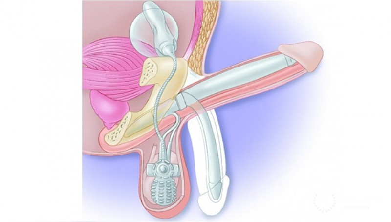 Фаллопротезирование