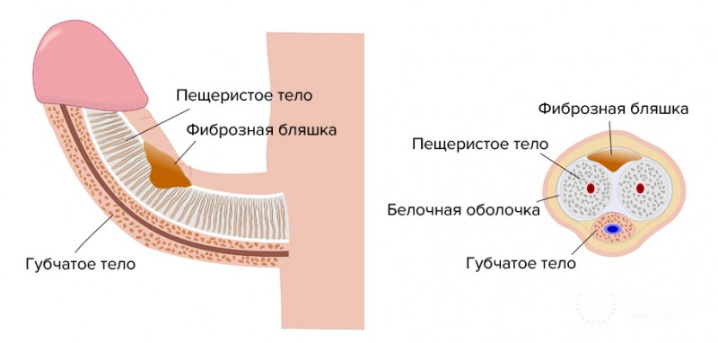 Болезнь Пейрони
