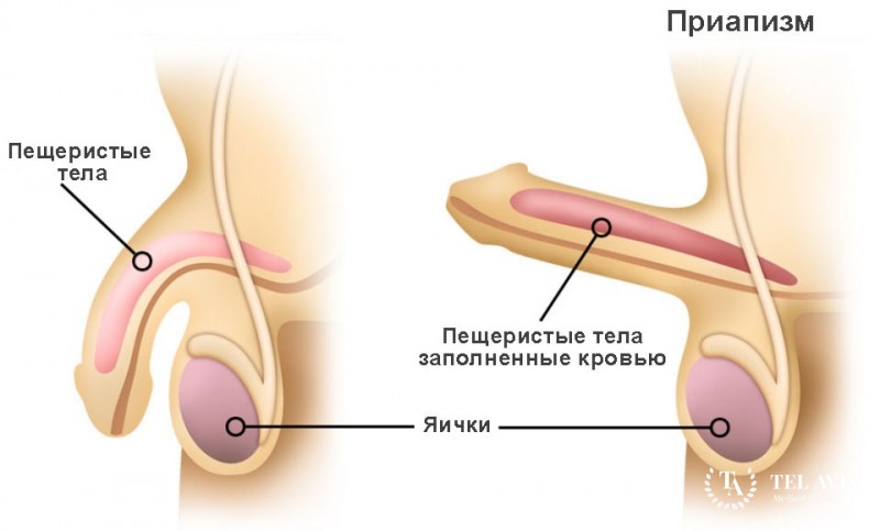 Приапизм