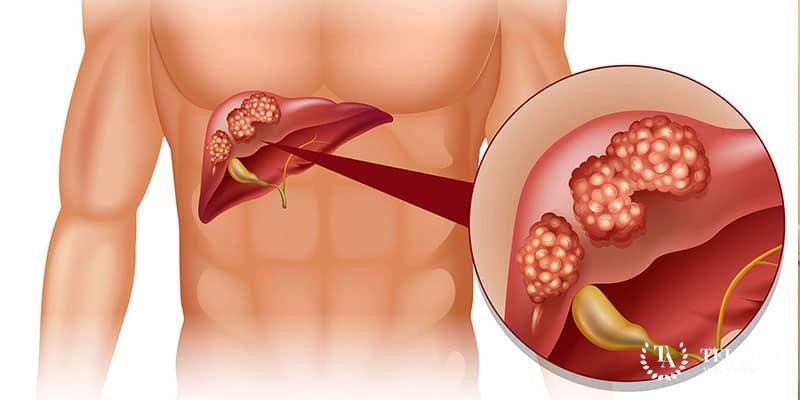 Гепатохолангиома - симптоматика и лечение