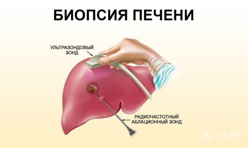 Биопсия печени под контролем УЗИ и КТ