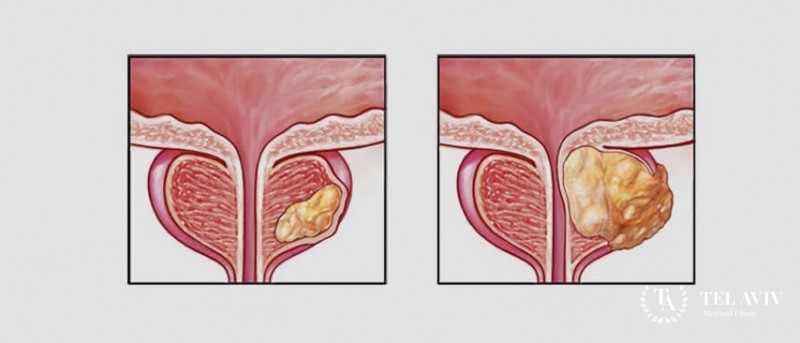 Полиморфноклеточный рак предстательной железы